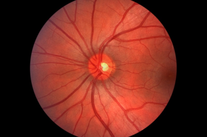 Glaucoma Centereach, NY